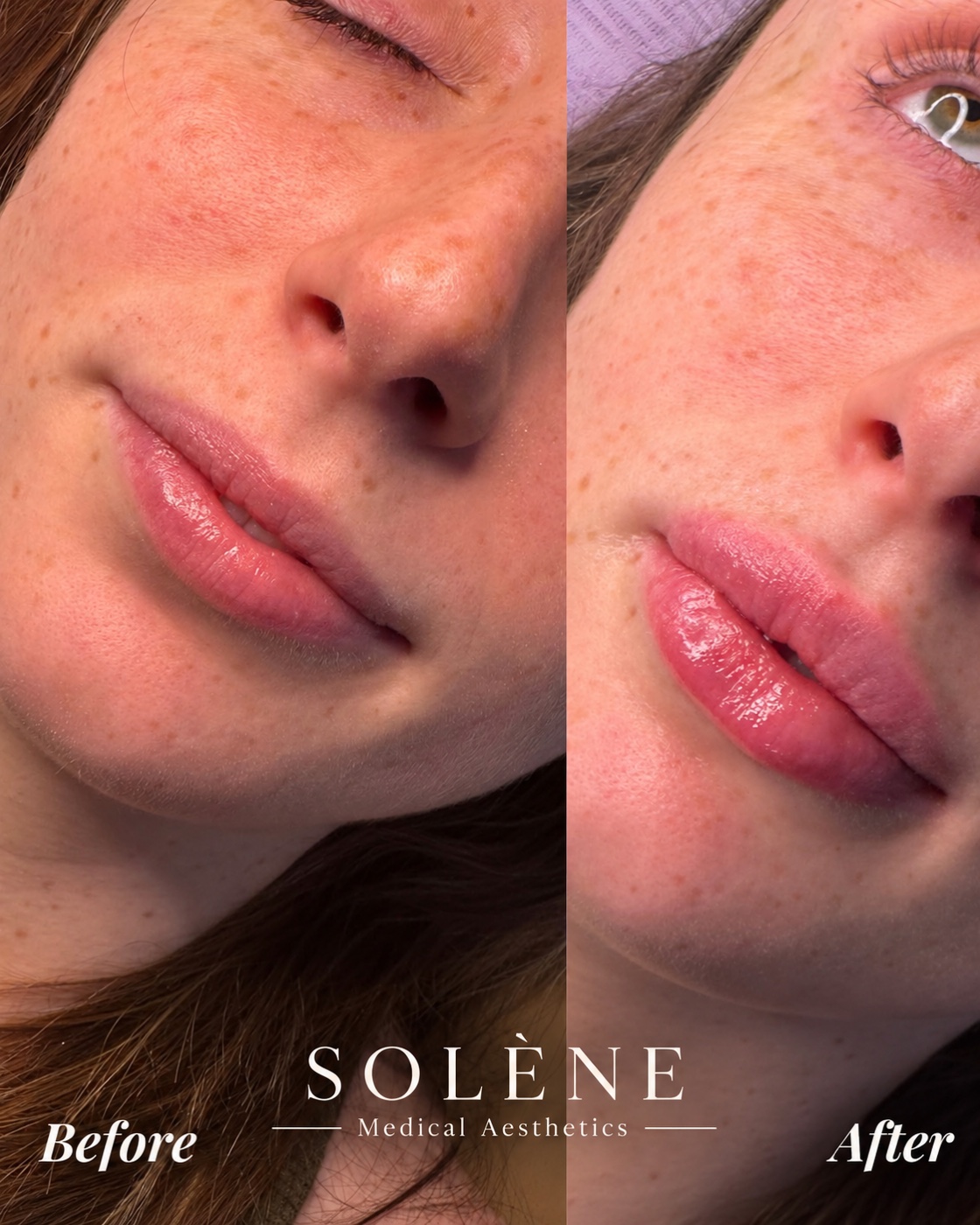 SOLÉNE client before and immediately after lip filler treatment