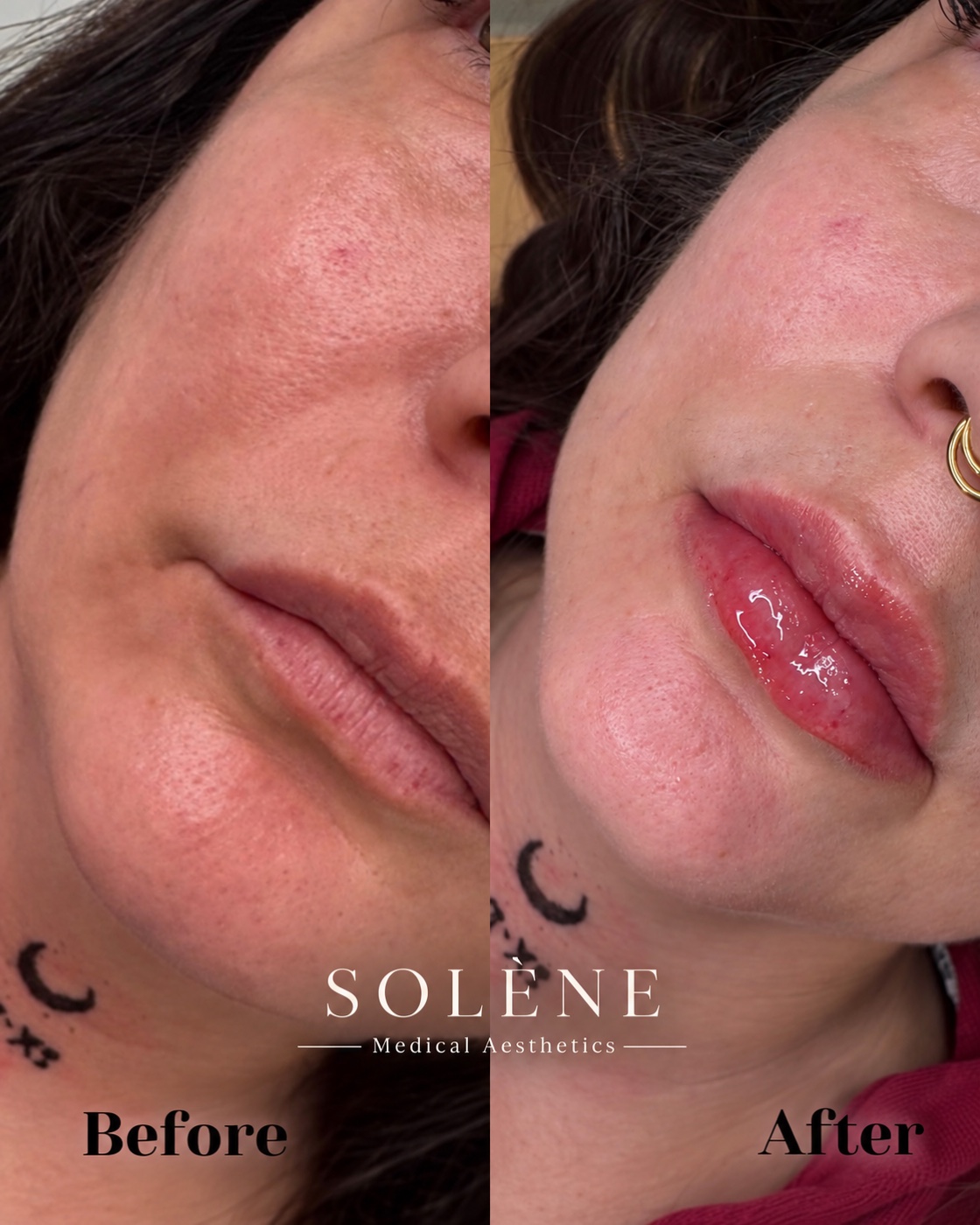 SOLÉNE client before and immediately after lip filler treatment