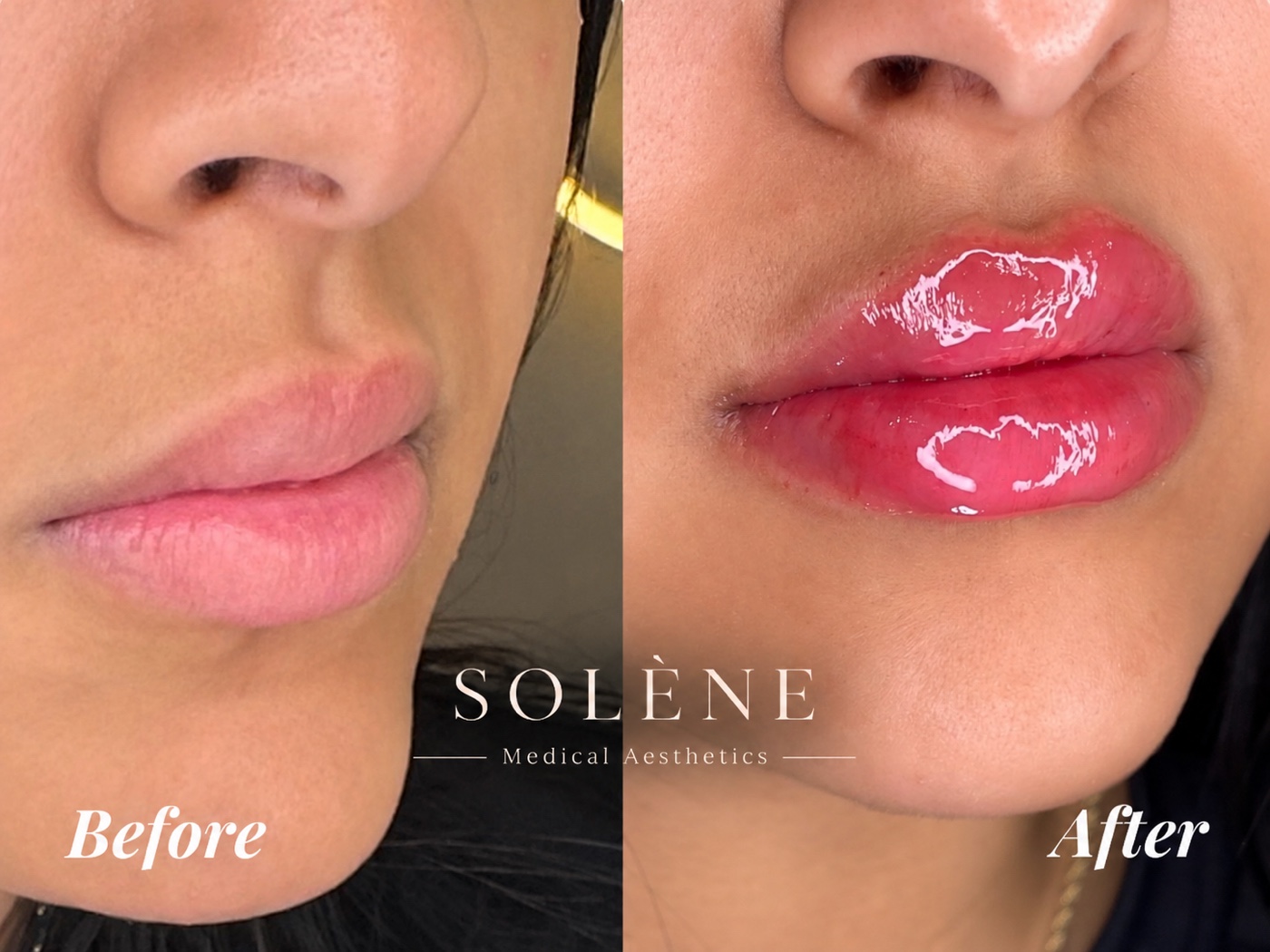 SOLÉNE client before and immediately after lip filler treatment