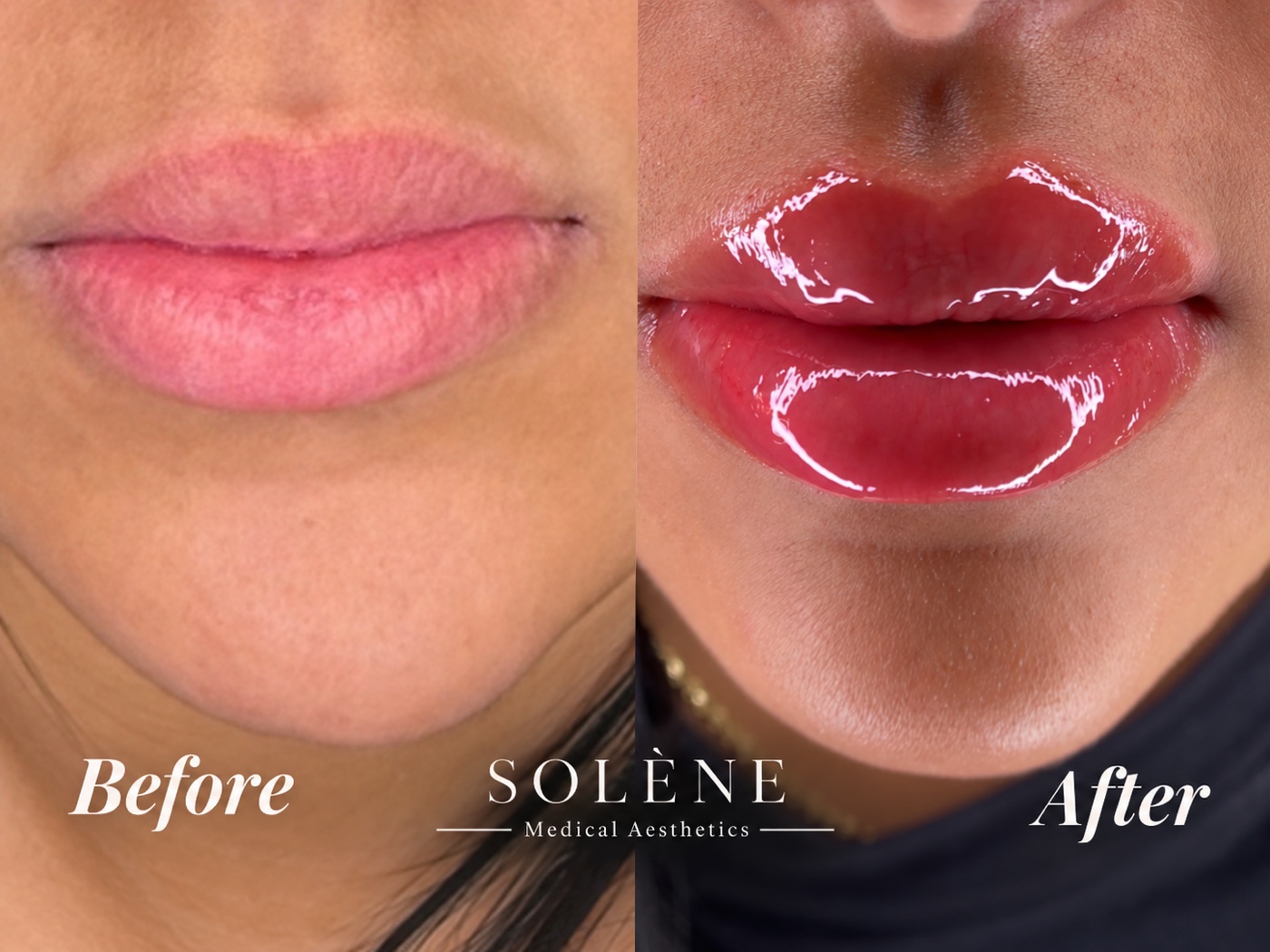 SOLÉNE client before and immediately after lip filler treatment