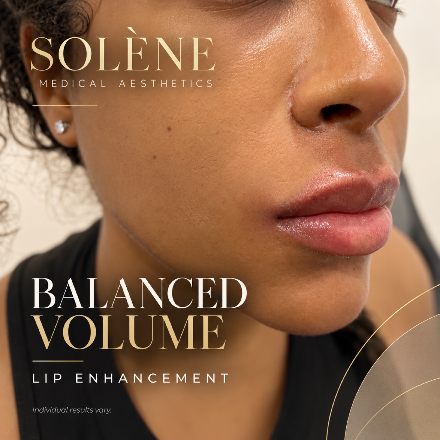 SOLÉNE balanced-volume lip enhancement