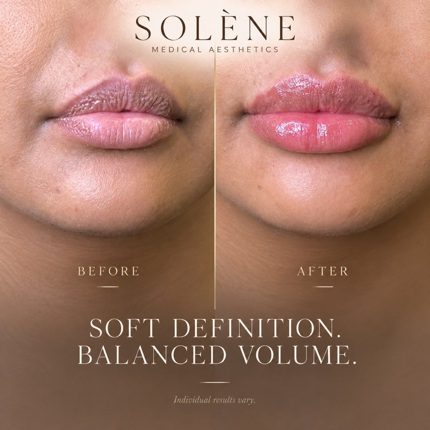 SOLÉNE lip enhancement before and immediately after treatment