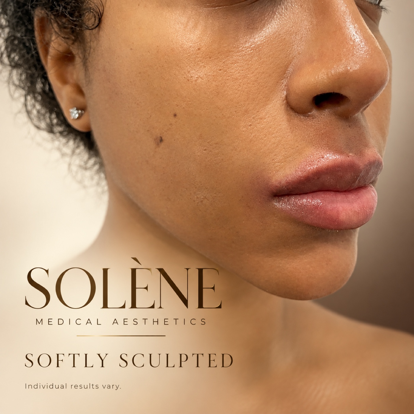 SOLÉNE lip enhancement with softly sculpted definition